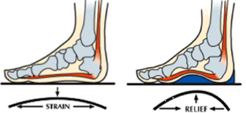 Posterior Calcaneal Spur